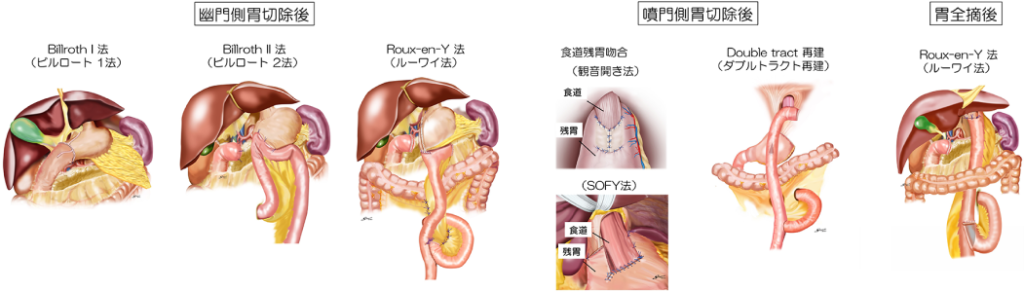 胃がんの治療 | 国立大学法人 東京医科歯科大学 消化管外科学分野